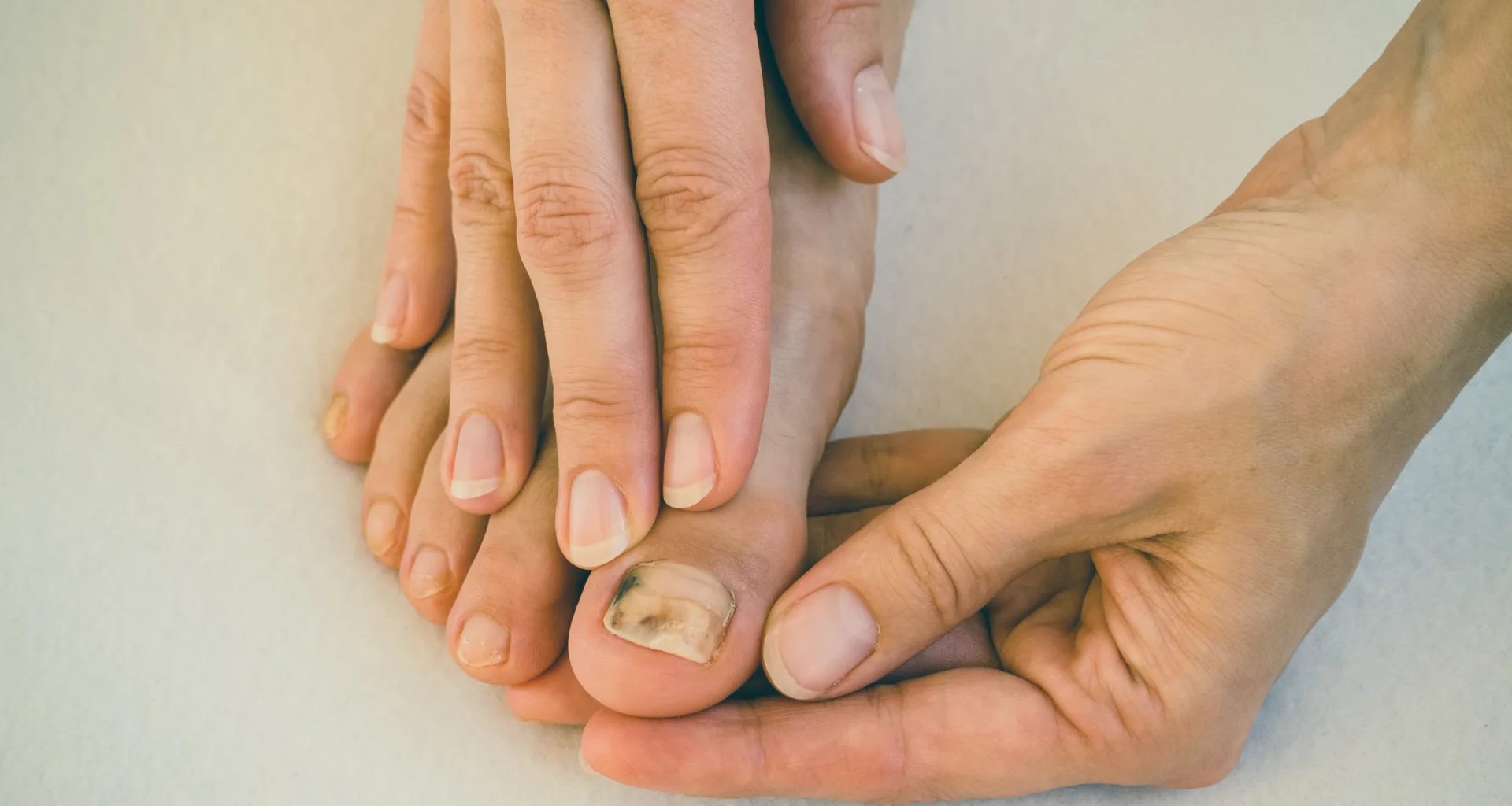 brzydkie paznokcie u stóp